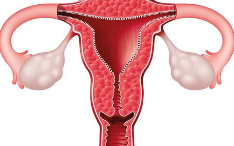 hidrosalpinks nedir belirtileri ve tedavi yontemleri