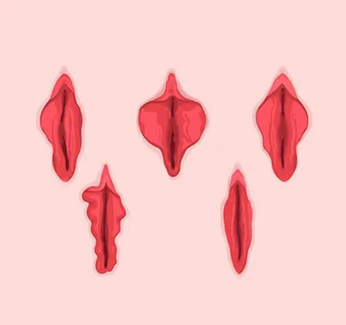 labioplasti ameliyati 2
