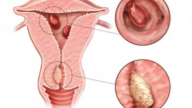 rahimdeki polip kansere donusur mu
